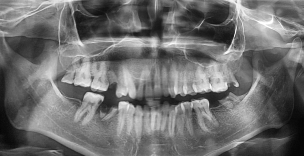 Panoramic radiograph reveals a well-defined unilocular radiolucent lesion in the anterior maxillary region with expansion of cortical plate.