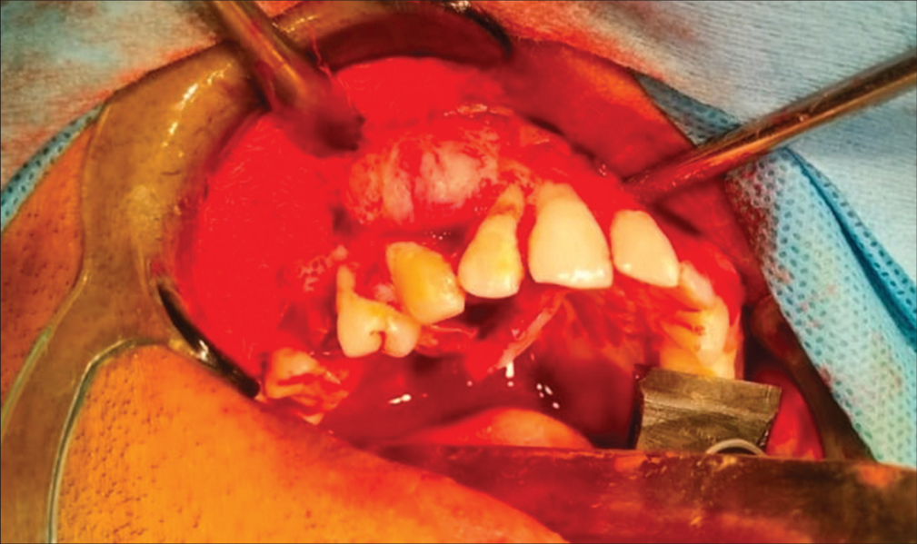 Surgical enucleation with curettage of the lesion.