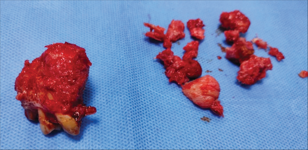 Gross specimen after surgical enucleation.