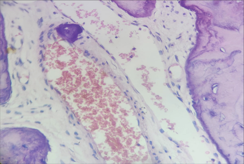 Photomicrograph showing fibrocellular stroma with osseous trabeculae and cementoid tissue.