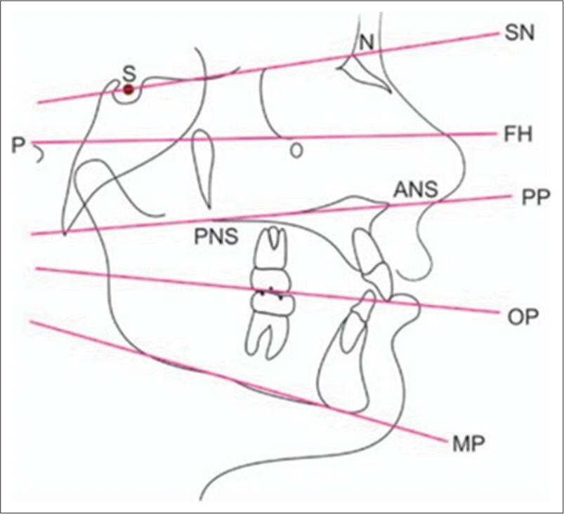 The horizontal plane according to Sassouni.[7] Munjal A, Alo A, Abraham SA, Jini B. A review of an open bite. Indian J Orthod Dentofac Res 2021;7:277-85.