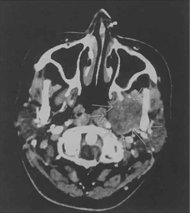 Computed tomography axial view revealed a mass measuring 3.5 cm × 3 cm arrows showing left side oropharynx mass.