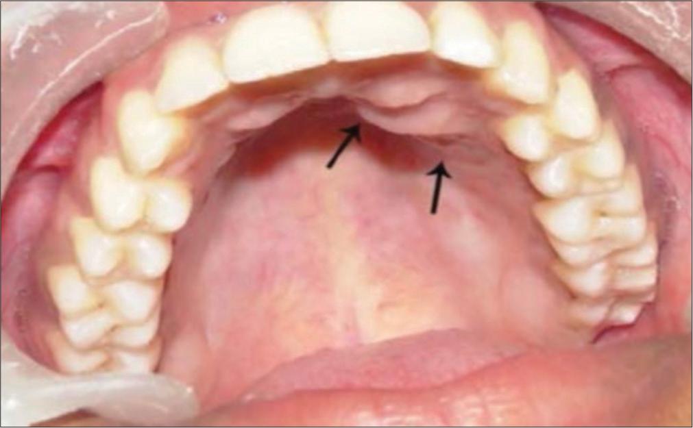 Anterior hard palate showing an ill-defined swelling in the left lateral incisor-canine region arrows showing 1 × 3 cms mass.