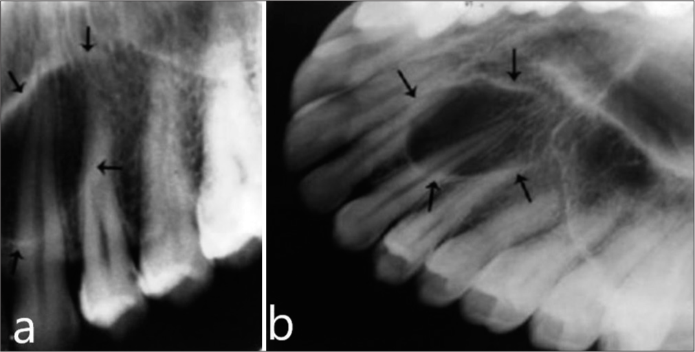 Intraoral periapical radiograph of maxillary left canine region (a) well circumscribed unilocular oval radiolucent lesion with interrupted cortical margins, first arrow showing extension from upper border to the second arrow superimposing over the root spices. (b) Arrows marking on Maxillary occlusal radiograph demonstrating unilocular radiolucent lesion extending from the left lateral incisor to first premolar, overlapping on their roots.