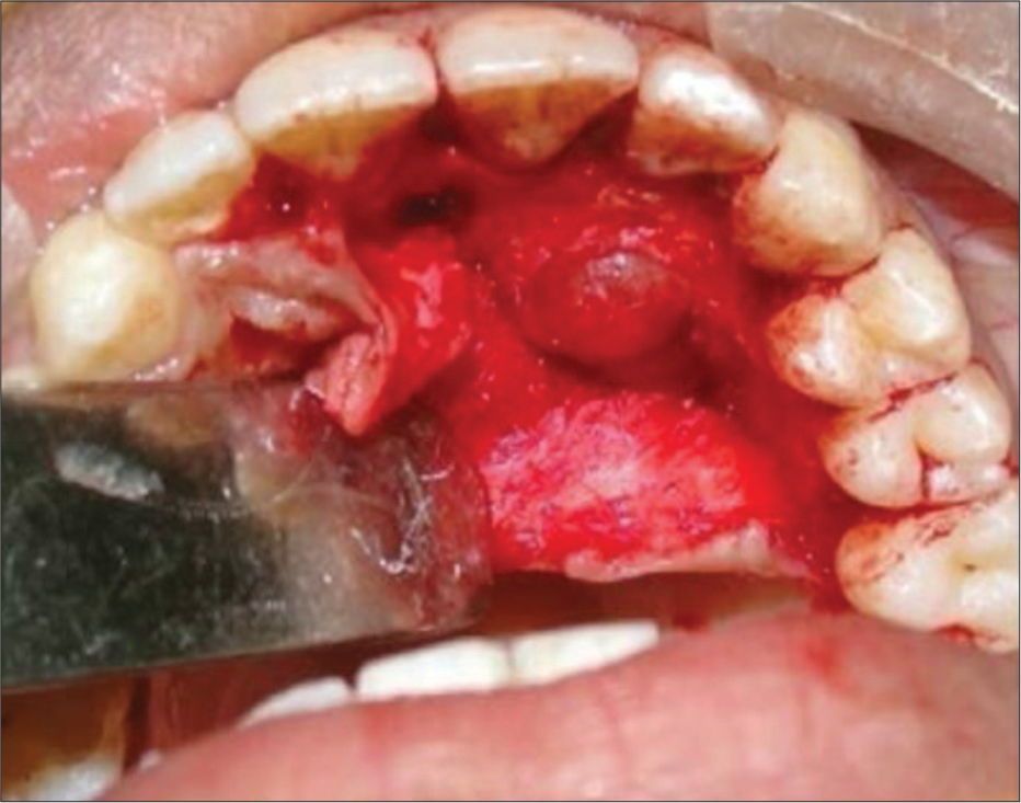 Surgical exposure revealing a well-encapsulated, unilocular lesion situated in the left lateral incisor-canine region.