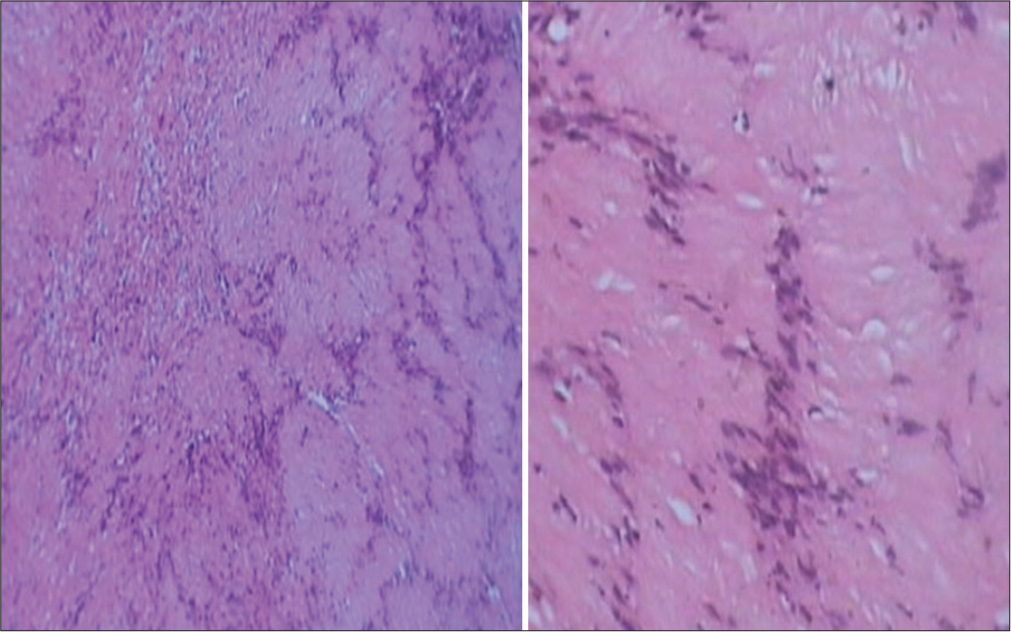 Photomicrograph of the lesion showing Antoni B tissue. Photomicrograph of the lesion composed of densely cellular and irregularly arranged, elongated spindle cells with palisading nuclei and Verocay bodies. Numerous blood vessels are seen interspersed throughout the histopath imaging.