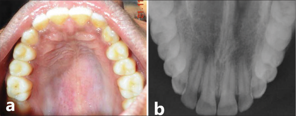 Two year post operative. (a) Clinical view of Maxilla. (b) Maxillary occlusal radiograph demonstrating palate with a normal trabecular pattern at the operated site indicating complete bone formation.