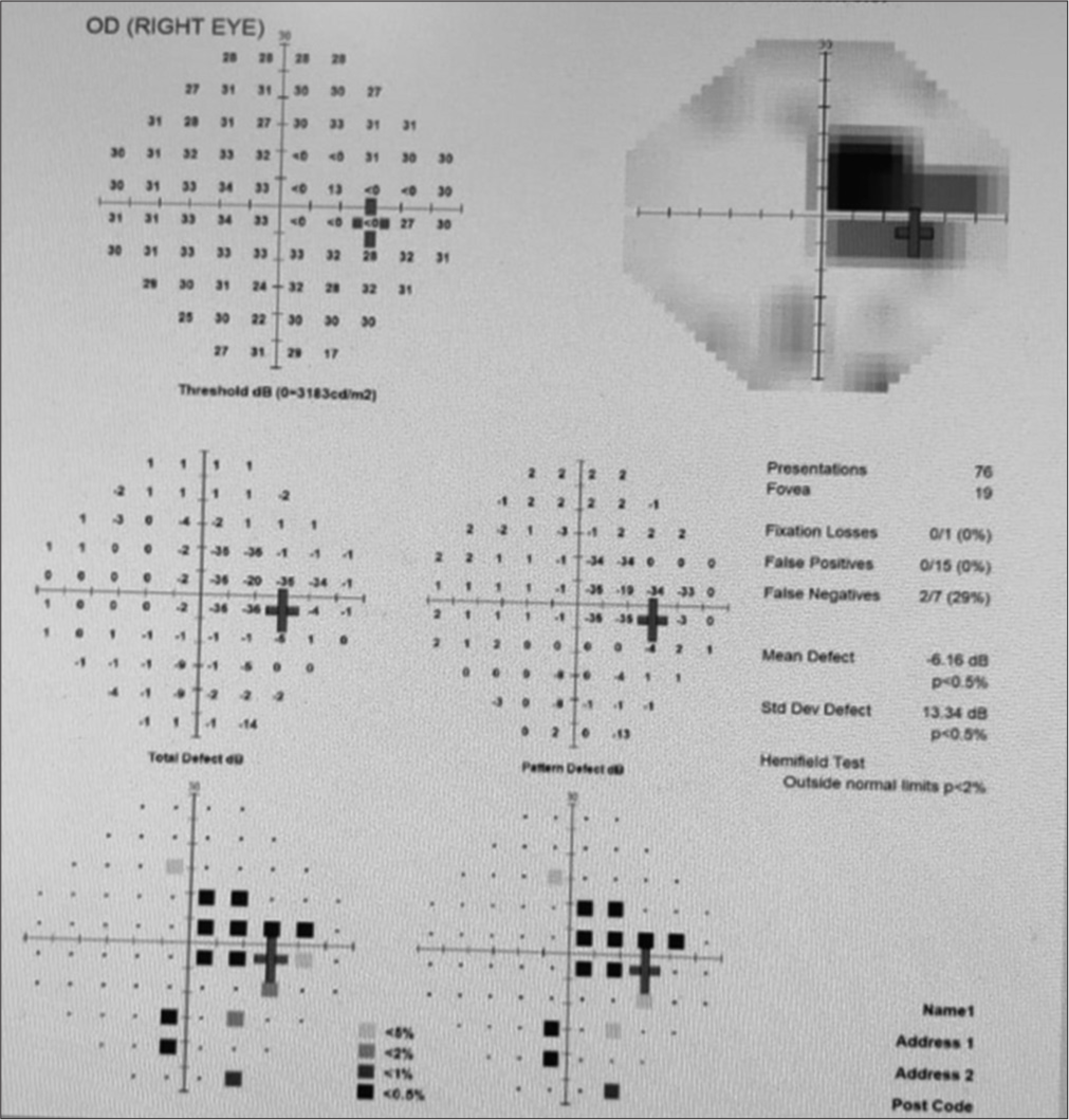 Perimetery of the right eye, on the day of presentation showing centrocaecal scotoma.