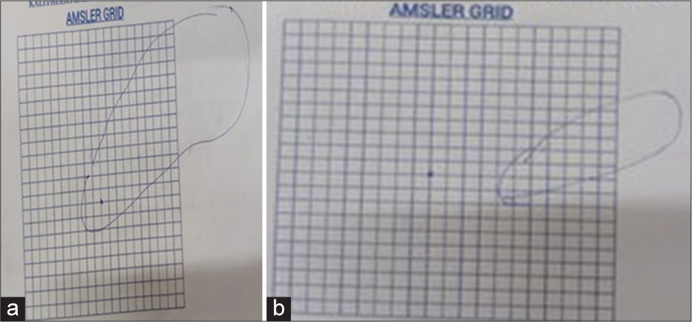 (a) Amsler grid, on the day of presentation (marked by patient). (b) Amsler grid, on follow-up.