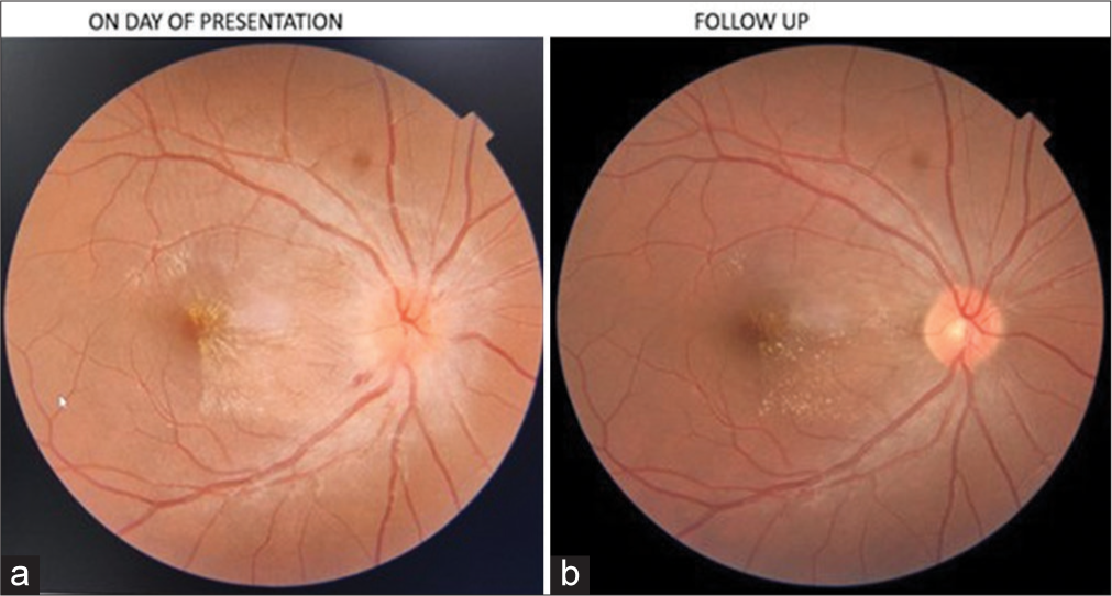 (a) Optical coherence tomography (OCT) fundus of the right eye, on the day of presentation. (b) OCT fundus of right eye, on follow-up.