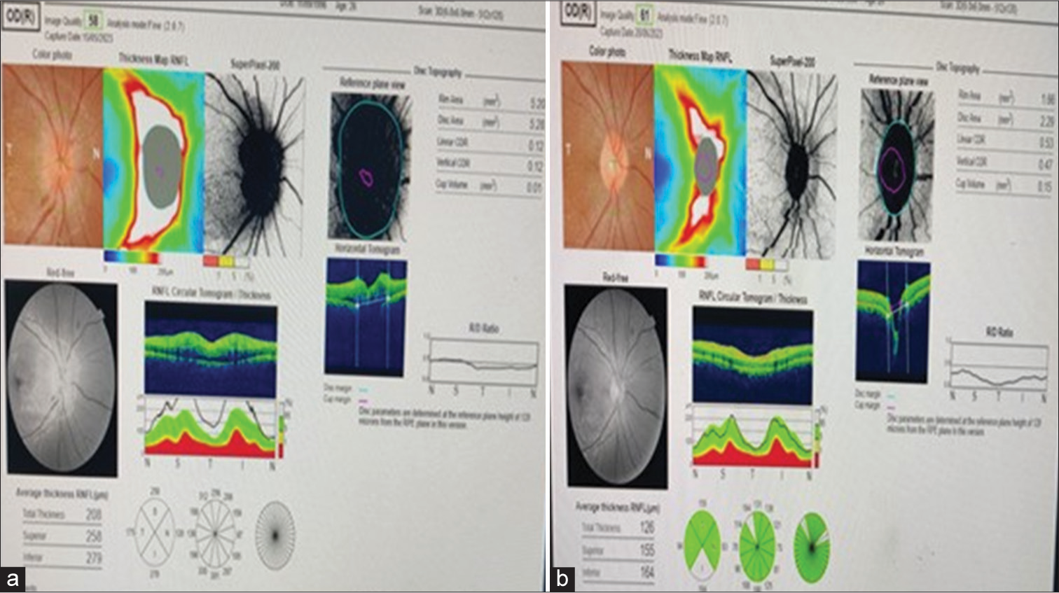 (a) Optical coherence tomography (OCT) disc of the right eye on the day of presentation. (b) OCT disc of the right eye on follow-up.