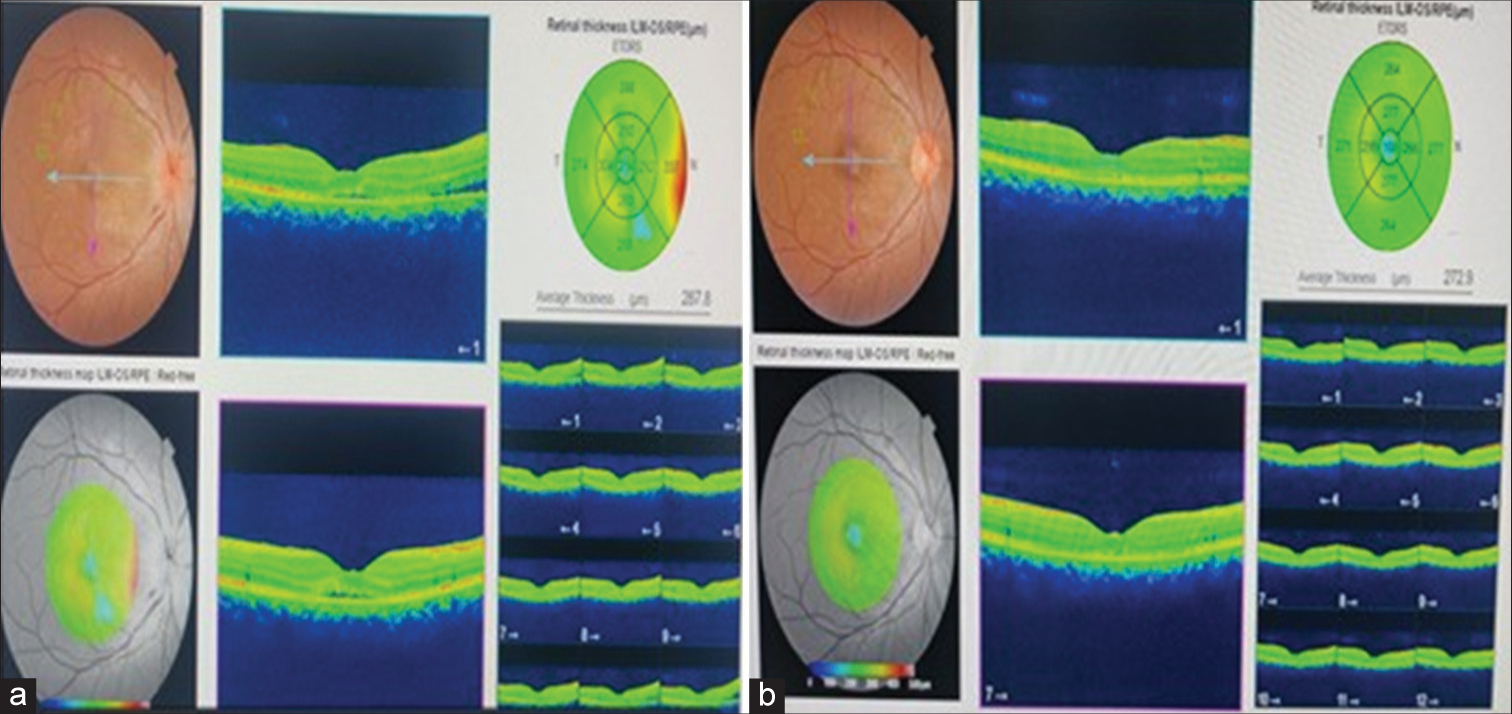 (a) Optical coherence tomography (OCT) macula of the right eye on the day of presentation. (b) OCT macula of the right eye on follow-up.