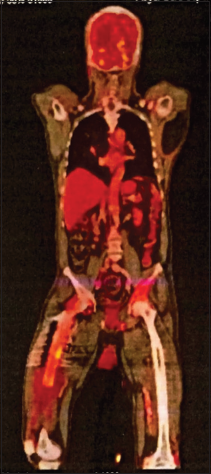 Features of polyostotic Paget’s disease.