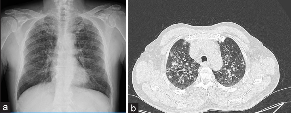 (a) Bilateral nodular densities and opacity increases, (b) Nodular infiltrations, with a partially recessed contour, emphysematous changes.